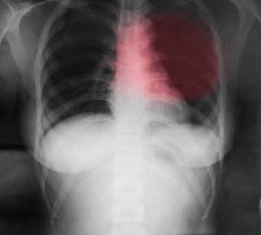 İnsan Göğsünün X-Ray Görüntüsü