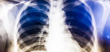 İnsan Göğsünün X-Ray Görüntüsü