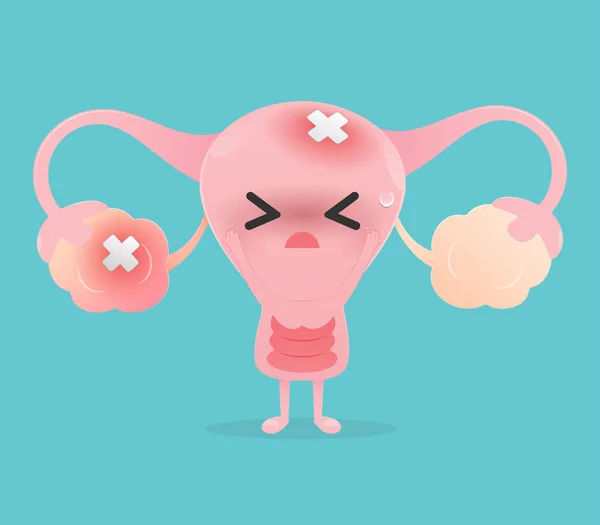 Illustration Uterus Entzündete Eierstock Vor Einem Blau Weißen Hintergrund Vector — Stockvektor