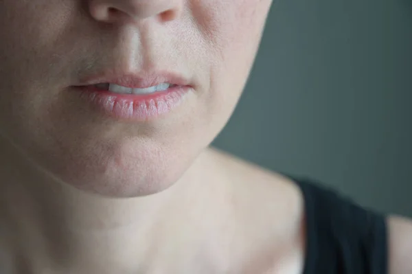 Volwassen Vrouw Lijdt Aan Een Zeer Droge Lippen — Stockfoto