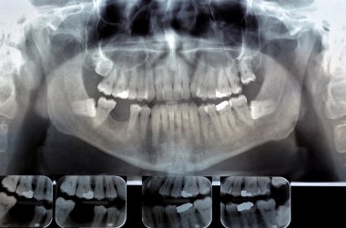 Dental radiography.  Digital x-ray teeth scan of adult male