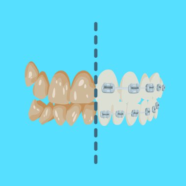 Çenenin dişli iki versiyonu. Kirli ve ağrıyan dişlere karşı diş telleri