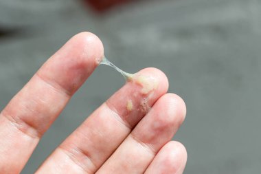 Hasta bir adamın elinde sümük var. Soğuk bir adamın elinde sümük var. Sümük hazır..