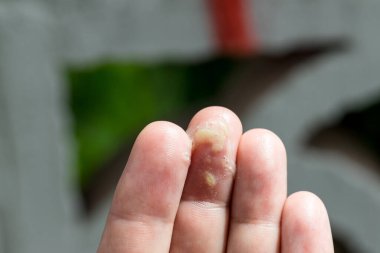 Hasta bir adamın elinde sümük var. Soğuk bir adamın elinde sümük var. Sümük hazır..