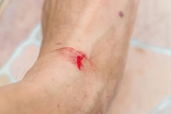 在花园里摔伤造成的伤害 脚上有伤痕的人 胳膊是刀伤的 血滴伤了皮肤 脚边的意外伤痕 — 图库照片