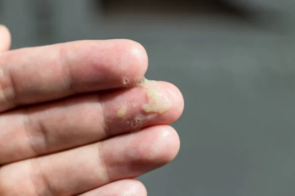 Homem Doente Tem Ranho Mão Homem Frio Tem Ranho Mão — Fotografia de Stock