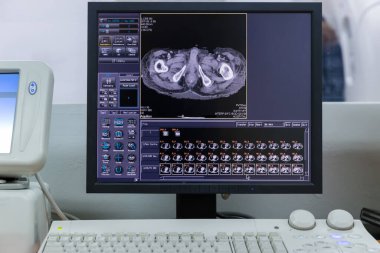 Bilgisayar ekranı MRI 'ı gösteriyor, beyin tomografisi. Karın tomografisi. Bilgisayar tomografisi alt ve orta karın bölgesini tarıyor.