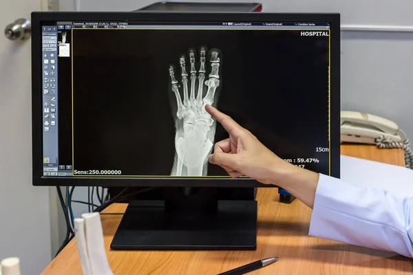 Der Arzt Zeigt Auf Den Problempunkt Fuß Auf Dem Röntgenfilm — Stockfoto
