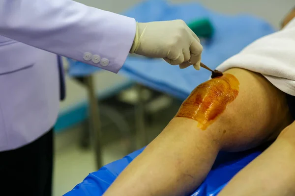 Médico Use Bata Blanca Unte Yodo Rodilla Del Paciente Para — Foto de Stock