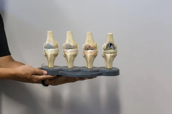 Doctor Show Anatomical Model Knee Displaying Progression Knee Osteoarthritis Which — Stock Photo, Image