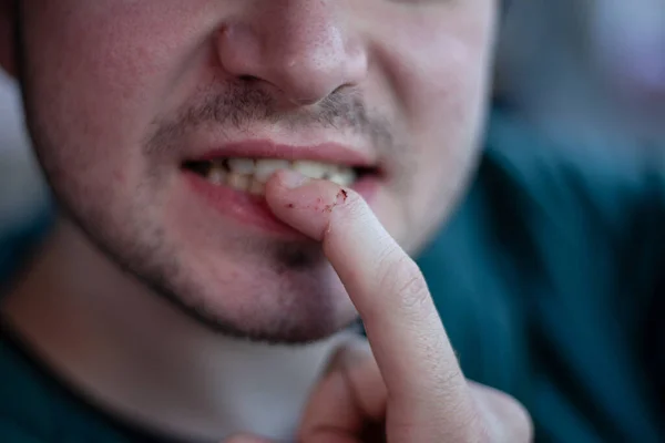 bad habits.Bite the nails. A hand with some ugly nails. disgusting bitten fingernails. Nervous man biting his nails in the street. male close-up, stubble.Not a perfect photo, yellow teeth