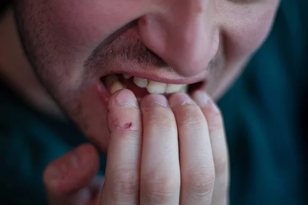坏习惯 咬钉子 一只指甲很丑的手恶心的被咬指甲 一个神经质的人在街上咬指甲 男性特写 照片不完美 黄色牙齿 图库照片