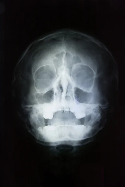 Ανθρώπινο κρανίο κεφάλι ακτίνων χ — Φωτογραφία Αρχείου