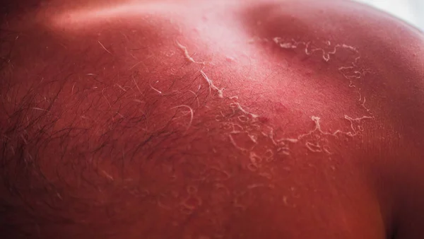 Peeling Pielea Spatele Uman Asemenea Cunoscut Sub Numele Vărsare Sau — Fotografie, imagine de stoc