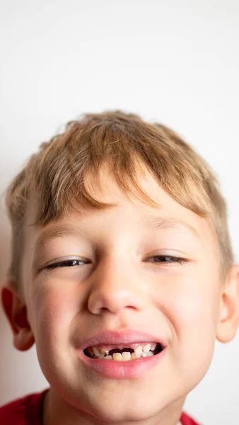 Portrait d'un garçon avec de mauvaises dents, dents supérieures avant tombées — Photo