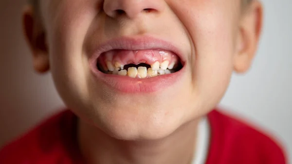 Retrato de un niño con dientes malos, dientes superiores caídos — Foto de Stock