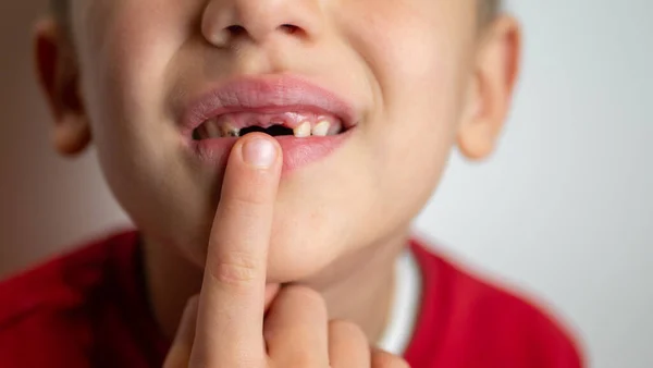 Retrato de un niño con dientes malos, dientes superiores caídos — Foto de Stock