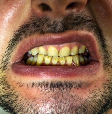 Sert ısırıktan ve sürekli ekşi içecek tüketiminden dolayı kırılmış ve kırılmış dişler..