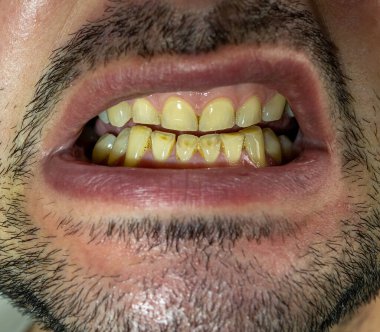 Sert ısırıktan ve sürekli ekşi içecek tüketiminden dolayı kırılmış ve kırılmış dişler.