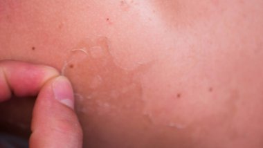 Güneş yanığından sonra deri dökülmesi. Aşırı bronzlaşmış. Güneş yanığının ciltteki etkileri, tırmanma derisi.