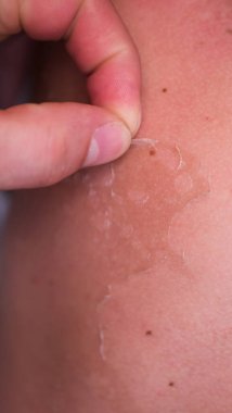 Güneş yanığından sonra deri dökülmesi. Aşırı bronzlaşmış. Güneş yanığının ciltteki etkileri, tırmanma derisi.