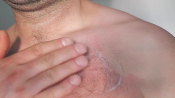 Nahaufnahme Mann Brust Hand Anwendung beruhigender Balsam Creme Lotion gegen Sonnenbrand Haut — Stockvideo