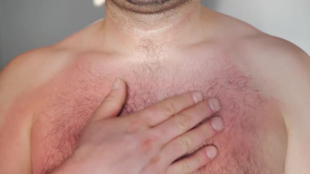 Primer plano mano del pecho del hombre la aplicación de crema de bálsamo calmante loción contra quemaduras solares piel — Vídeo de stock