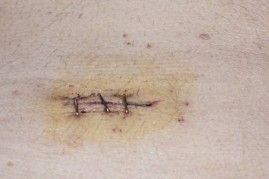 Kolesistektomi için laparoskopi yapıldıktan sonra karın bölgesinde cerrahi kesikler var. Dikiş iğneleri flaş ışığı ile kapatılmış.