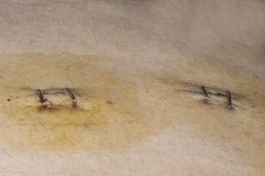 Kolesistektomi için laparoskopi yapıldıktan sonra karın bölgesinde cerrahi kesikler var. Dikiş iğneleri flaş ışığı ile kapatılmış.