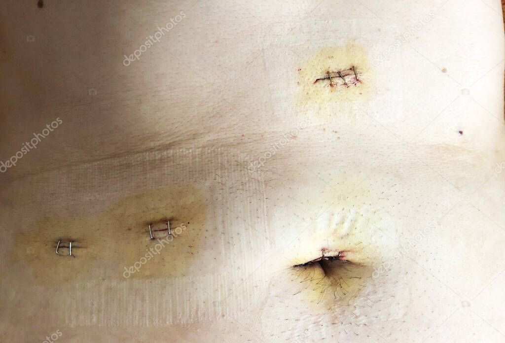 Surgical incisions in the abdomen after laparoscopy for cholecystectomy closed with suture staples flash lighting