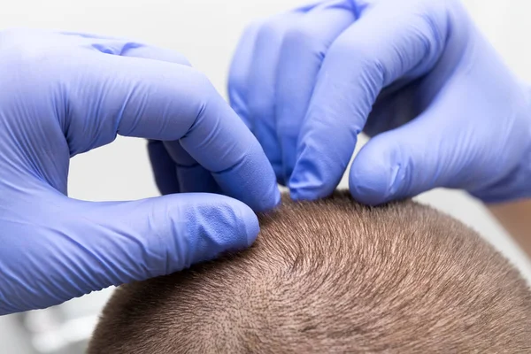 Doktor saç tellerinde bit ve bit var mı diye bakar. Bir dermatolog kafa derisi, saç kökü, kellik, saç kaybı, egzama ve kepek hastalıklarını inceler. Tıbbi lateks eldivenli eller..