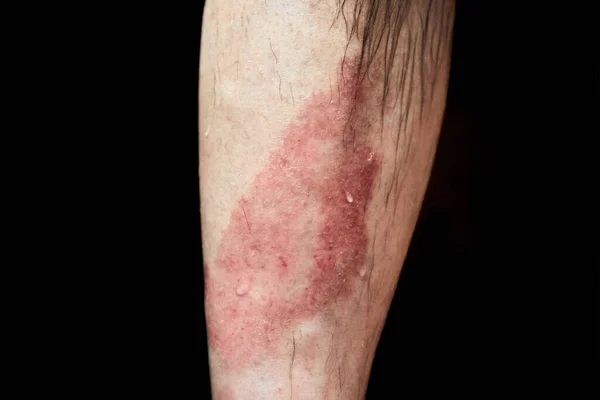 A patient with psoriasis, an autoimmune skin disease. Large red spot on the calf. Copy space. Redness of a part of the body. Chronic illness. Blur background. Close-up. Burn male leg. Immune problem.