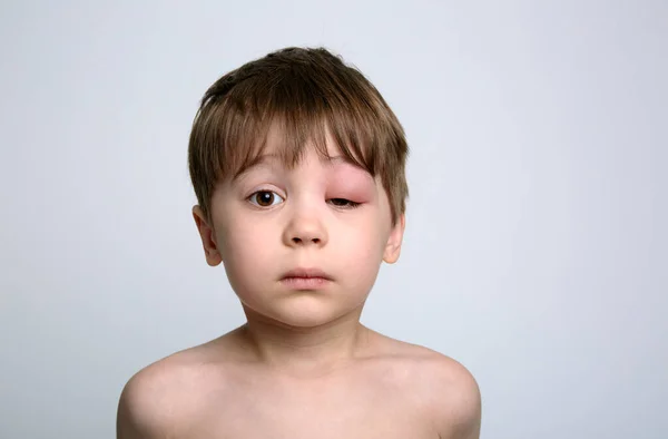 Chlapec Oteklým Okem Kousnutí Hmyzem Quincke Edém Portrét Bělošského Dítěte — Stock fotografie