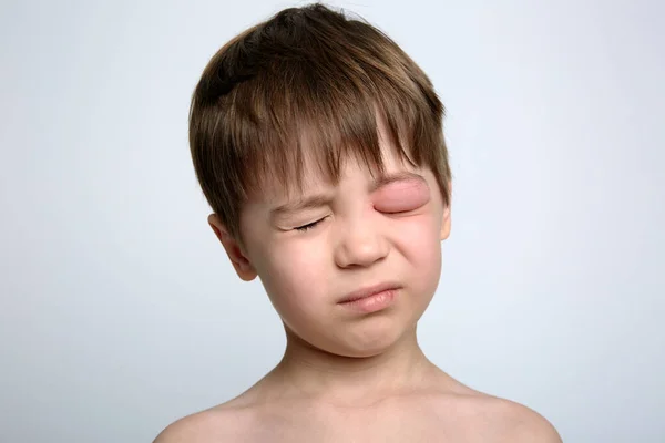 虫刺されから目が腫れている少年 クインケ浮腫 カメラを見ている白人の外観の子供の肖像画 スタジオの背景 隔離されてる アレルギーの人の顔 コピースペース スタジオだ アレルギー — ストック写真