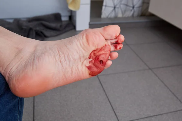 Лазерное Удаление Бородавки Ноги Вырезать Verruca Сразу После Операции Кровь — стоковое фото