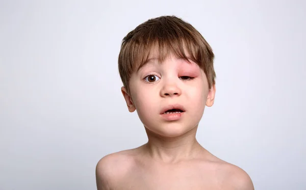 虫刺されから目が腫れている少年 クインケ浮腫 カメラを見ている白人の外観の子供の肖像画 スタジオの背景 隔離されてる アレルギーの人の顔 コピースペース スタジオだ アレルギー — ストック写真