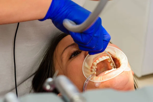 Dişleri Tartardan Temizledikten Sonra Dişçi Sadece Steril Enstrümanlar Kullanarak Suyla — Stok fotoğraf