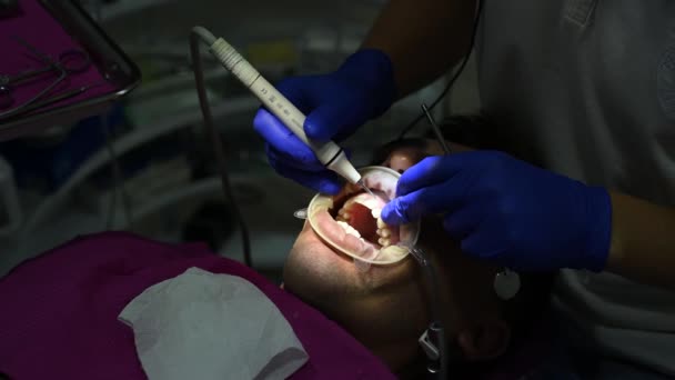 Zubař pomocí ultrazvuku odstraňuje zubní kámen a tvrdou plak na zubech. — Stock video