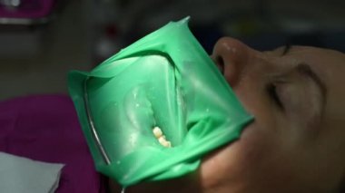 Diş hekimi hastanın dişlerini tedavi eder. Kaliteli tedavi için kauçuk baraj kullanır..