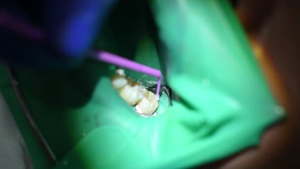 歯医者は歯の形で充填を形成し 口腔はゴム製のダムで覆われており クローズアップ — ストック動画