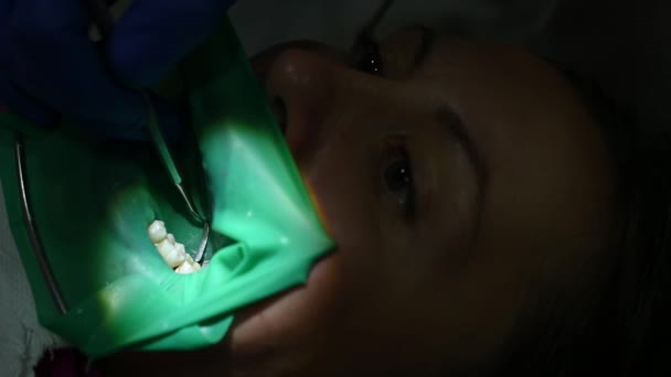 Стоматолог Формирует Пломбу Форме Зуба Полость Рта Покрыта Резиновой Плотиной — стоковое видео