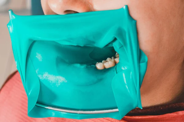 Dentist Installs Rubber Dam Sterile Dental Treatment Modern Equipment Dentistry — Stock Photo, Image