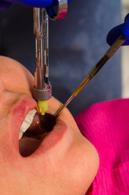 Lokal anestezi, anestezi, şırınga enjeksiyonu, dişçi hastaya iğne yapıyor. 2020