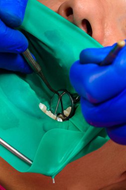 Çiğneme yüzeyinin yenilenmesi, 2020 Lastik Baraj Sistemi vasıtasıyla fotopolymer ile doldurulmasını sağlayacak malzemelerle yapılır.