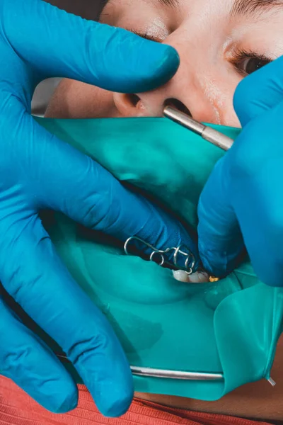 Dentista Trata Dente Paciente Com Uma Barragem Borracha Broca Espelho — Fotografia de Stock