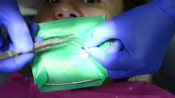 De patiënt in een stoel in het kantoor van de tandarts, voert tandheelkundige ingrepen, tandheelkundige behandeling. — Stockvideo