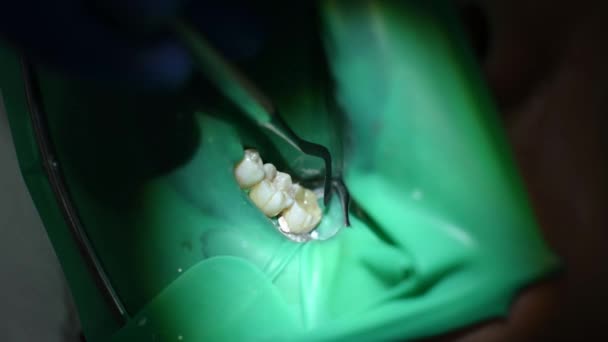 Ο οδοντίατρος σχηματίζει μια πλήρωση στο σχήμα ενός δοντιού, η στοματική κοιλότητα καλύπτεται με ένα ελαστικό φράγμα, close-up. — Αρχείο Βίντεο