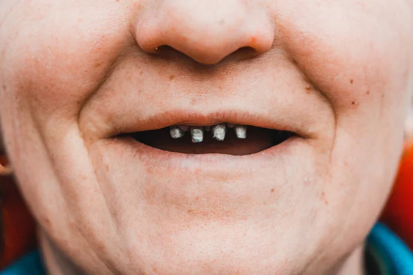 Kobieta Szeroko Otworzyła Usta Pokazała Jej Krzywe Zgniłe Zęby Bliska — Zdjęcie stockowe