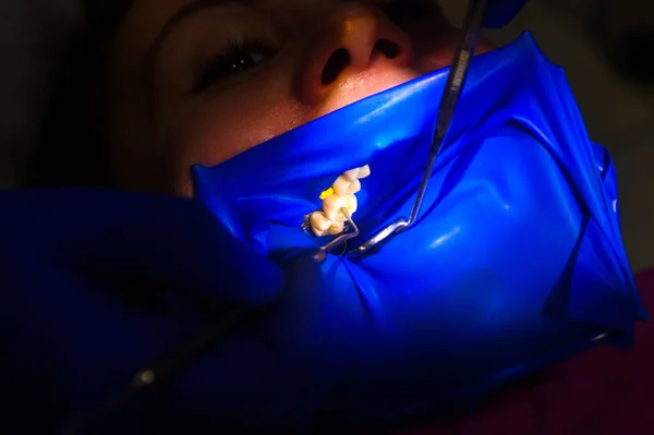 Close-up of the patient\'s mouth after filling the teeth with white composite resin on the insulation of a rubber dam, rubber dam and dental mirror. new