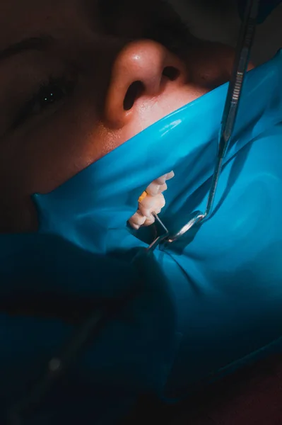 Close-up of the patient\'s mouth after filling the teeth with white composite resin on the insulation of a rubber dam, rubber dam and dental mirror. new